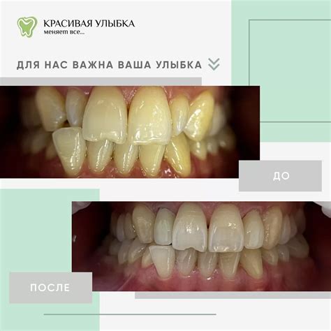  Циркониевые коронки: прорыв в стоматологии 