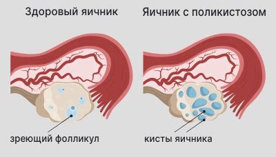 Альтернативные методы лечения гиперплазии эндометрия