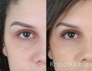 Альтернативные методы устранения темных кругов