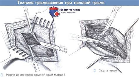 Безопасные и эффективные методы массажа при паховой грыже