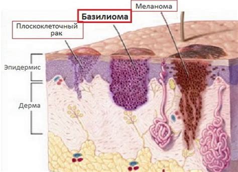 Бородавки - распространенное явление на коже