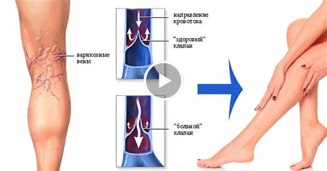 Варикозное расширение вен: зуд в результате нарушения кровотока