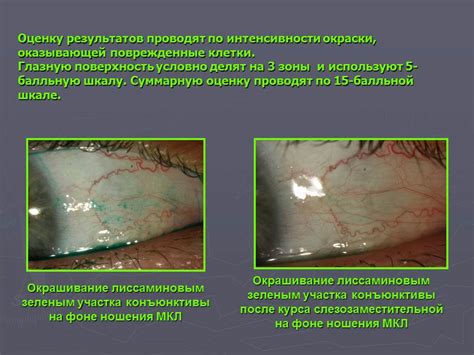 Влияние контактных линз на заживление после хирургического вмешательства