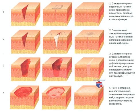 Влияние левомеколя на заживление раны