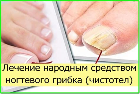 Влияние покраски ногтей на развитие грибка