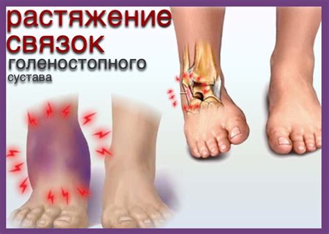 Влияние растяжения голеностопа на общую физическую активность