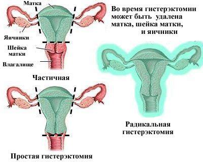 Возможности удаления матки