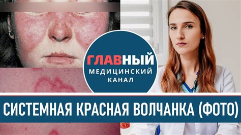 Возможные последствия системной красной волчанки