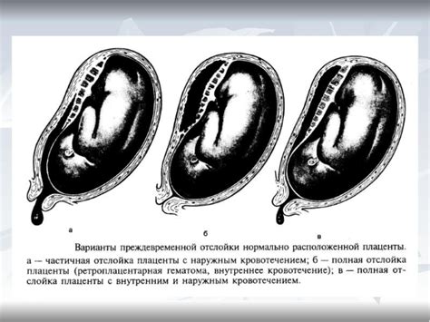 Возможные причины быстрого изменения положения плаценты