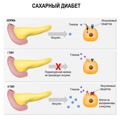 Возможные причины изменения температуры при сахарном диабете