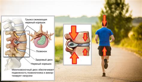 Вы можете бегать с пупочной грыжей?