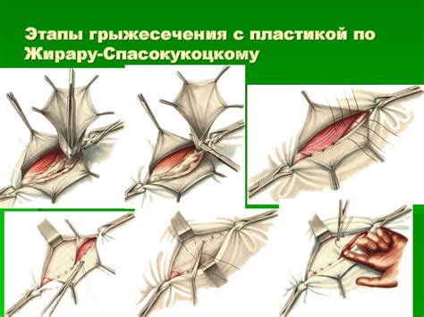 Грыжа пахового канала: диагностика и лечение