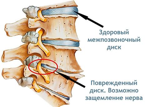 Диагностика грыжи на позвоночнике