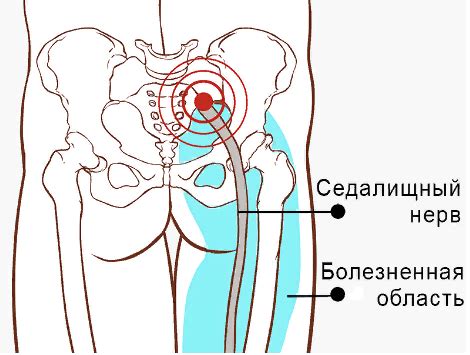 Диагностика отека при защемлении седалищного нерва