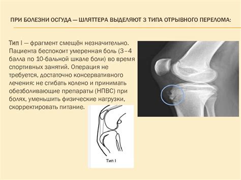 История заболевания Осгуд Шляттера и связь с физической активностью