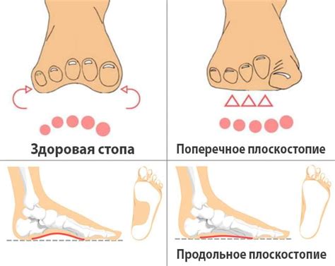 Какие виды плоскостопия освобождают от физкультуры?