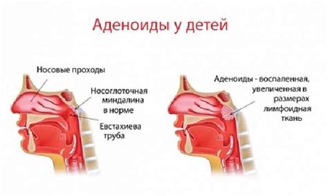 Какие симптомы могут возникнуть при загрузках после удаления аденоидов