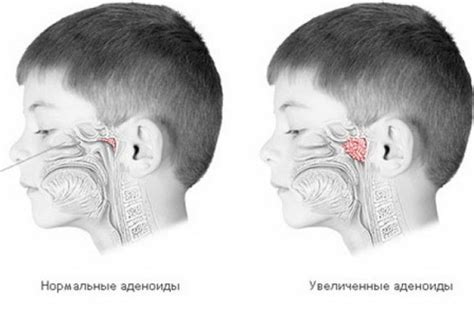 Как аденоиды влияют на дыхательную систему