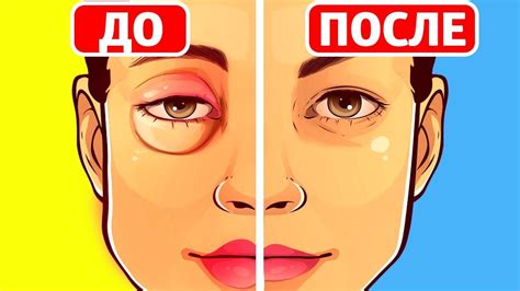 Как быстро убрать отёк с лица?