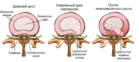 Как возникают грыжи позвоночника?