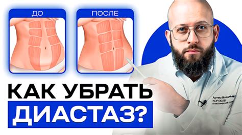 Как диастаз воздействует на фигуру?