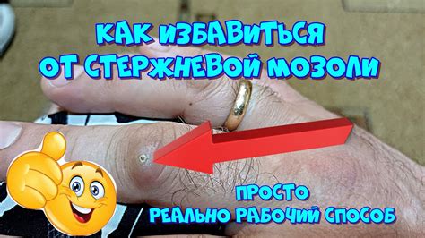 Как избавиться от болезненной мозоли?