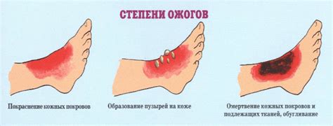 Как избежать образования шрамов после ожога второй степени?