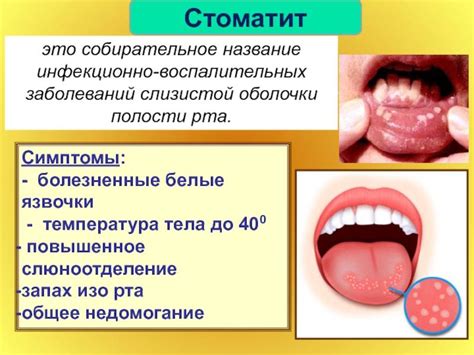 Как лечить стоматит и снижать температуру