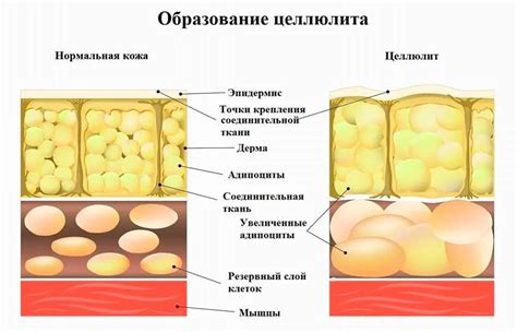 Как образуется целлюлит и почему это проблема