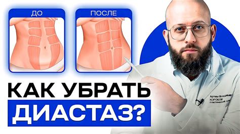 Как определить наличие диастаза и его степень?