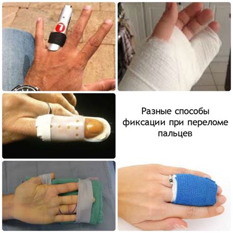 Как правильно диагностировать перелом пальца