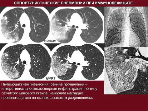 Компьютерная томография и пневмония