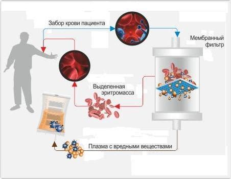 Краткий обзор процесса плазмафереза