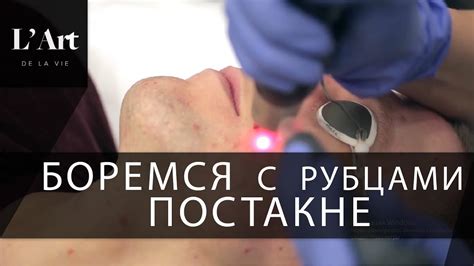 Лазерное удаление носогубки
