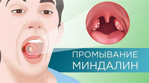 Методы выдавливания гноя с миндалин