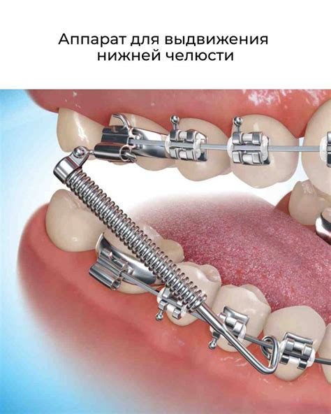 Методы выдвижения нижней челюсти без применения брекетов