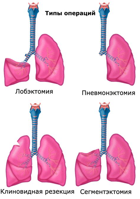 Методы и последствия операции при раке легких с метастазами