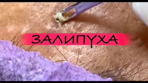 Метод 3: Выдавливание гноя самостоятельно