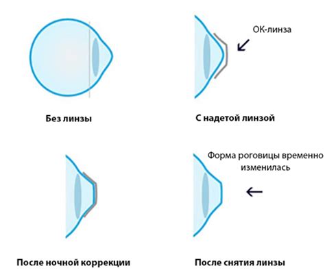 Минусы ношения ночных линз для детей