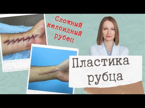 Может ли келоидный рубец проходить самостоятельно?