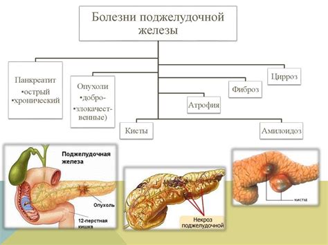 Нарушение работы поджелудочной железы