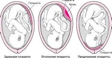 Насколько быстро может измениться положение плаценты