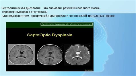 Наследственность в формировании полости прозрачной перегородки