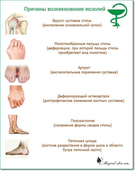 Натуральные способы удаления твердых мозолей