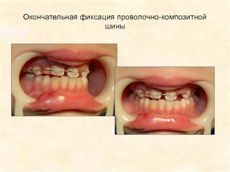 Окончательная фиксация