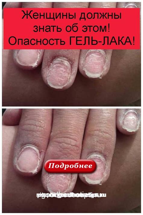 Опасность оставления гель лака на коже