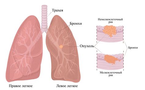 Операция при раке легких с метастазами: решение специалистов