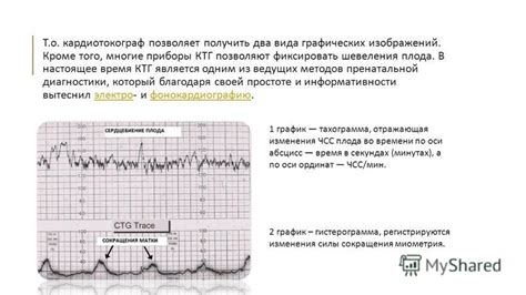 Определение схваток на КТГ: возможности и ограничения