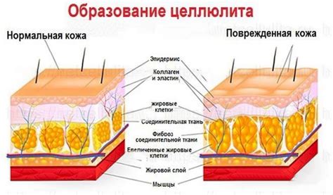 Основные признаки целлюлита