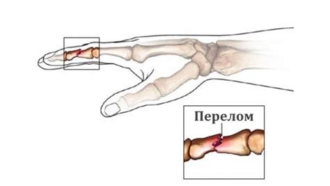 Основные симптомы перелома пальца